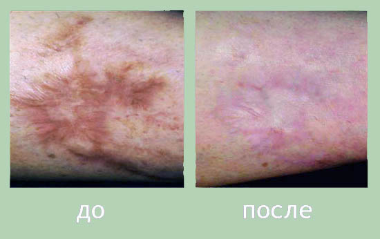 Отторжение пересаженной кожи Отторжение пересаженной кожи